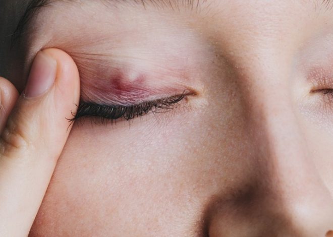 Discover Six Home Remedies for Eye Stye