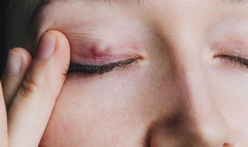 Discover Six Home Remedies for Eye Stye