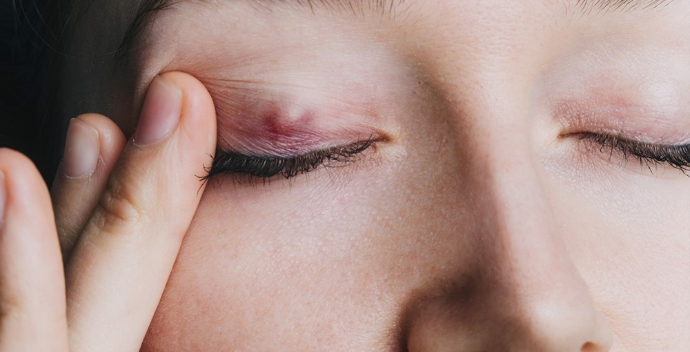 Discover Six Home Remedies for Eye Stye