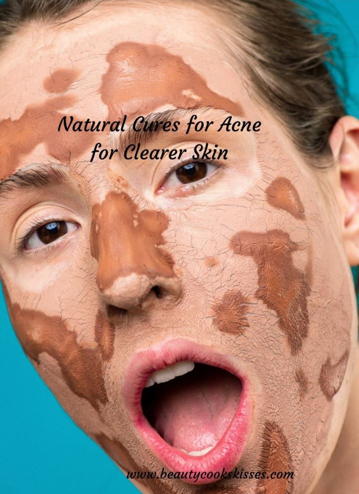 Natural Cures for Acne for a Clearer Complexion