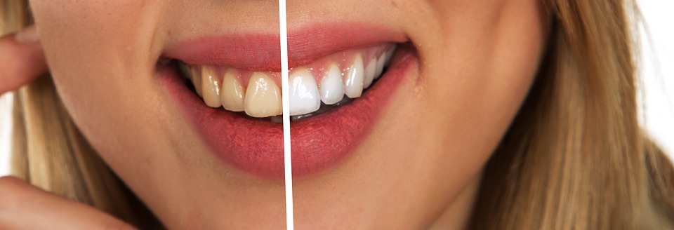 Teeth Whitening Dangers You Want to Avoid