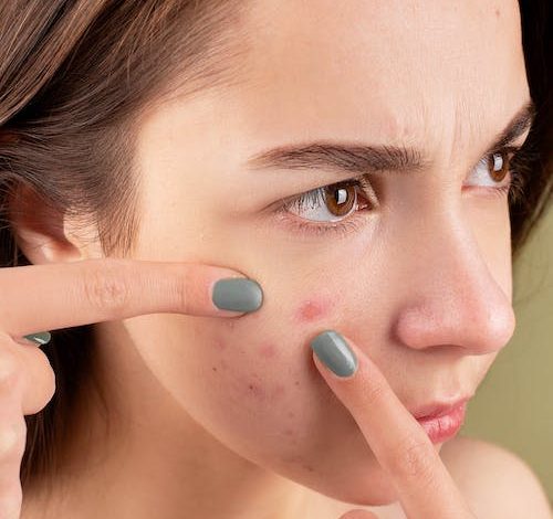 Adult Acne: Beyond the Basics – How to Reclaim Your Clear Skin